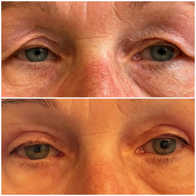Lidhautstraffung( Oberlid-Blepharoplastik) 