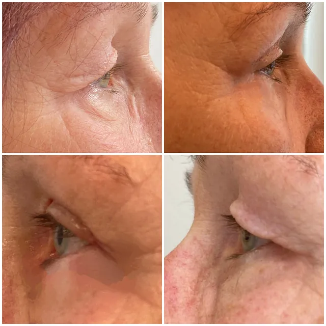 Lidhautstraffung( Oberlid-Blepharoplastik) 