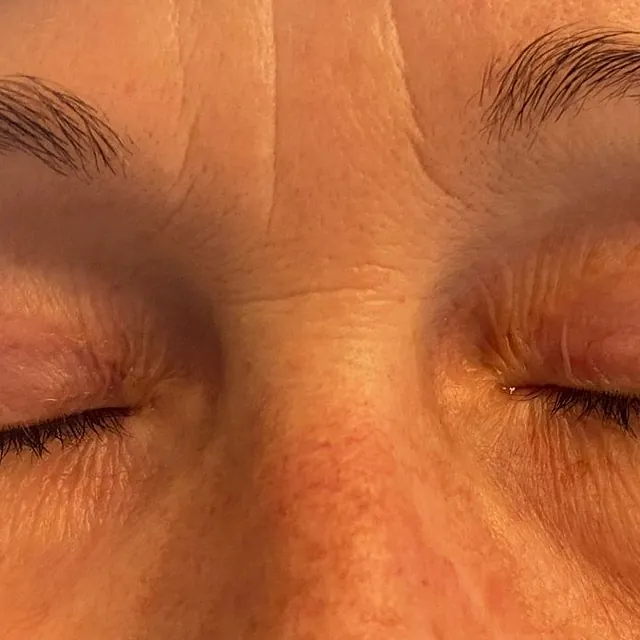 Lidhautstraffung( Oberlid-Blepharoplastik) 
